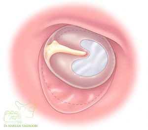 Tympanoplasty