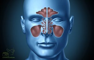 Sinusitis