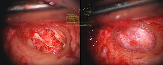 Tympanoplasty