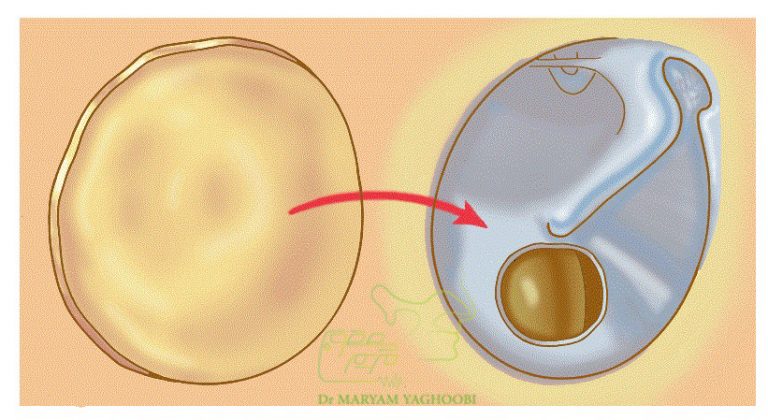 Tympanoplasty