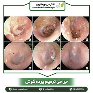 جراحی ترمیم پرده گوش - دکتر مریم یعقوبی