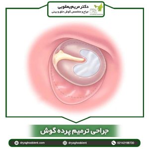 ترمیم پرده گوش - دکتر مریم یعقوبی