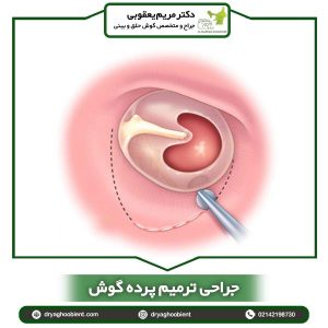 جراحی ترمیم پرده گوش _ دکتر یعقوبی