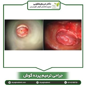 جراحی برای ترمیم پرده گوش - دکتر مریم یعقوبی