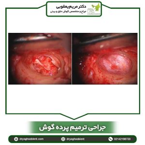 ترمیم پرده گوش - دکتر یعقوبی