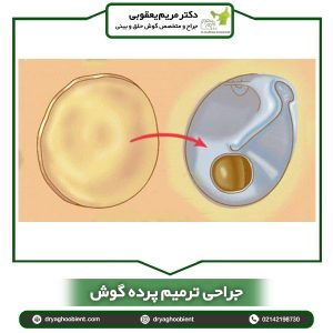 جراحی ترمیمی پرده گوش - دکتر یعقوبی