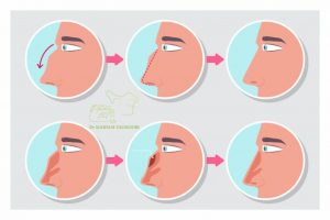 جراحة الأنف