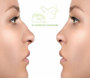 جراحی بینی استخوانی