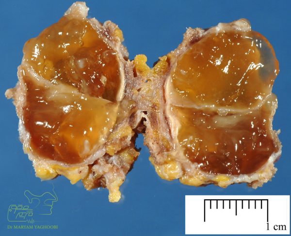 Thyroglossal cyst
