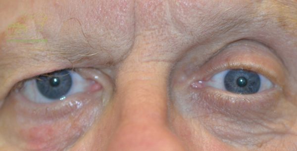 Bell's Palsy