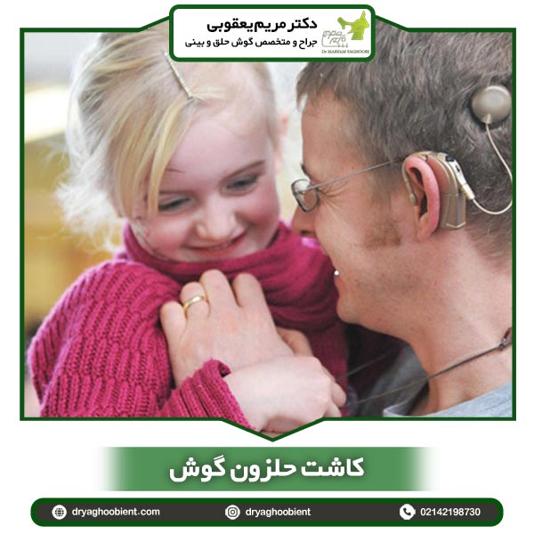 کاشت حلزون گوش