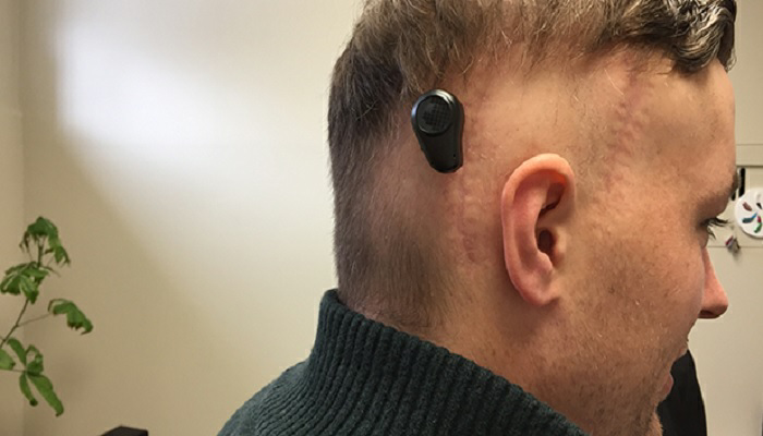 ایمپلنت‌های شنوایی