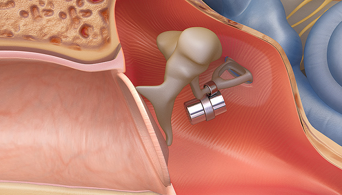 ایمپلنت‌های مربوط به گوش میانی (MEI)