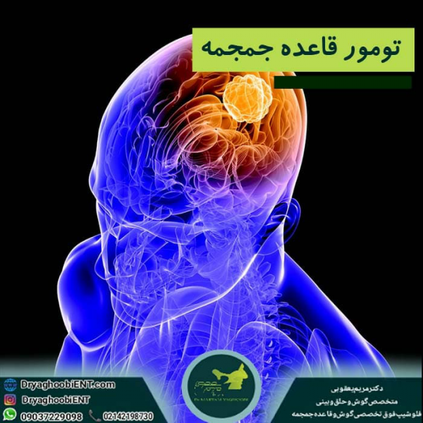 تومورهای قاعده جمجمه