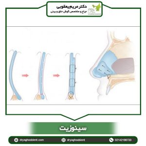 سینوزیت - دکتر مریم یعقوبی