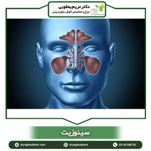 سینوزیت - دکتر یعقوبی