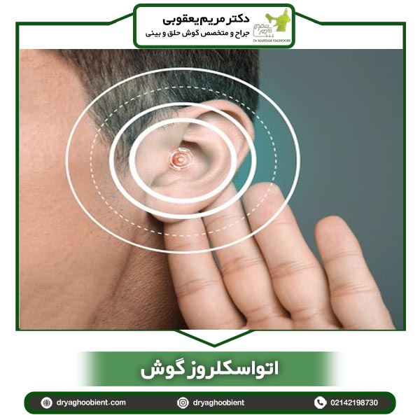 اتواسکلروز گوش-دکتر یعقوبی