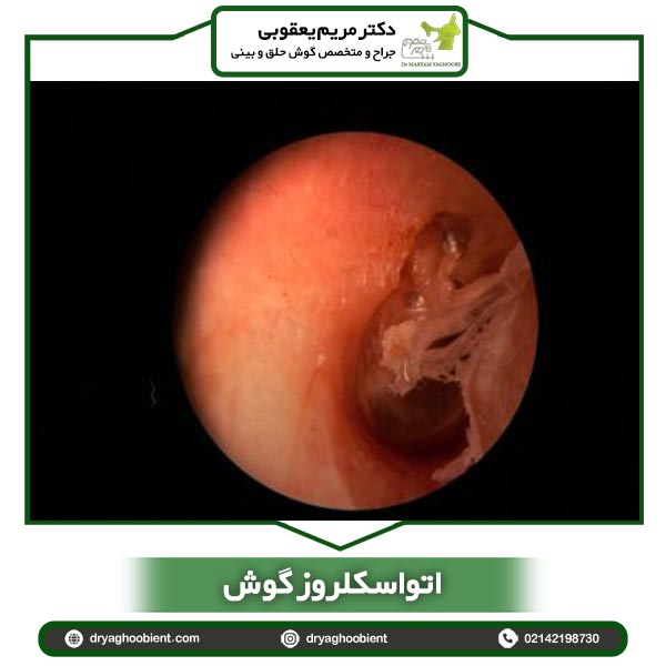 اتواسکلروز گوش-دکتر یعقوبی