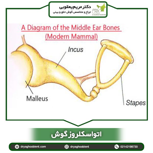 اتواسکلروز گوش