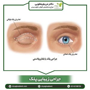 جراحی زیبایی پلک- دکتر مریم یعقوبی