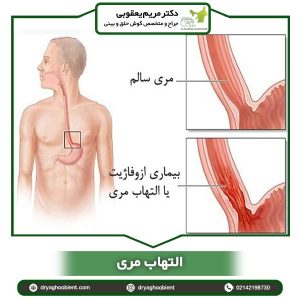 التهاب مری _ دکتر مریم یعقوبی