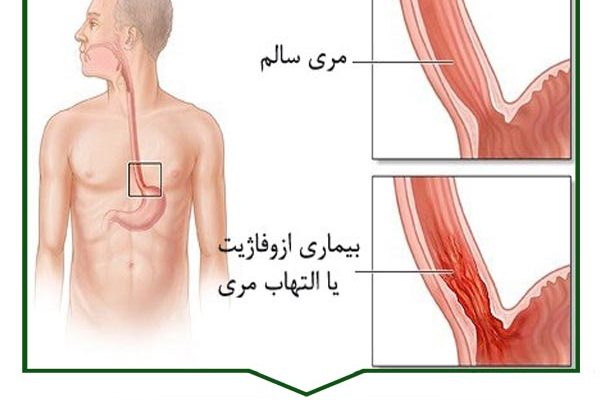 التهاب مری