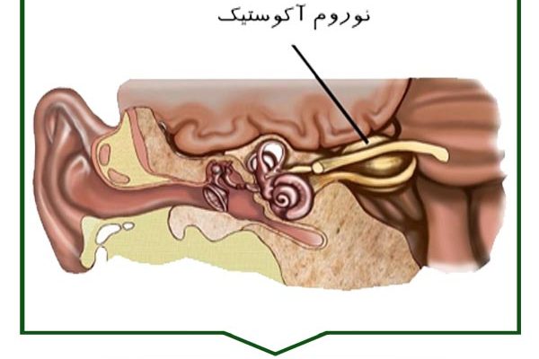 تومورهای گوش