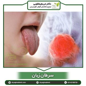 سرطان زبان - دکتر یعقوبی