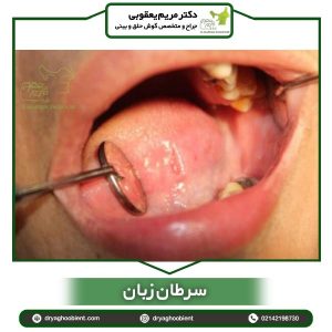 سرطان زبان - دکتر یعقوبی