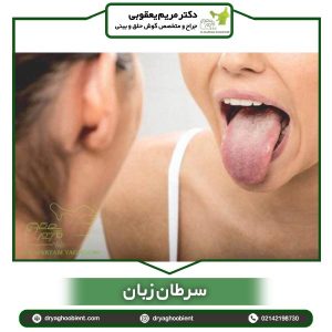 سرطان زبان - دکتر یعقوبی