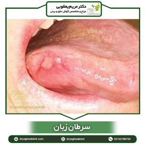 سرطان زبان - دکتر مریم یعقوبی