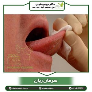 سرطان زبان - دکتر یعقوبی