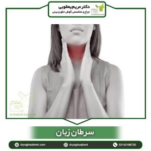 سرطان زبان - دکتر یعقوبی