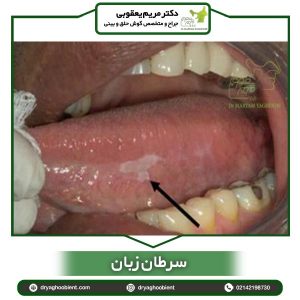 سرطان زبان - دکتر یعقوبی