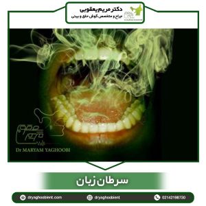 سرطان زبان - دکتر یعقوبی