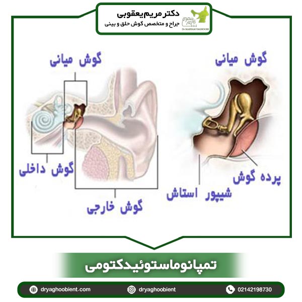 تمپانوماستوئیدکتومی در تهران - دکتر یعقوبی