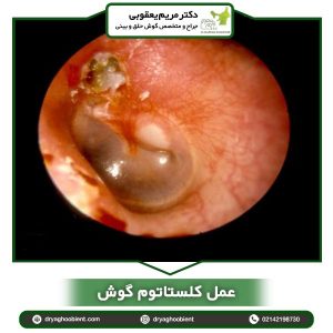 عمل کلستاتوم گوش _ دکتر مریم یعقوبی