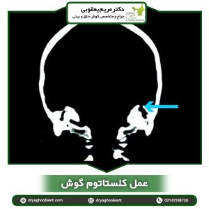 عمل کلستاتوم گوش _ دکتر یعقوبی