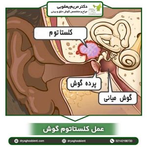 عمل کلستاتوم گوش _ دکتر یعقوبی