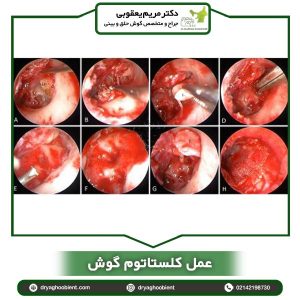 عمل کلستاتوم گوش _ دکتر یعقوبی