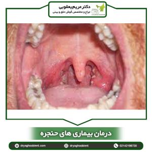 درمان بیماری های حنجره