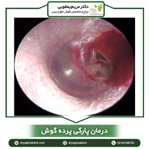 درمان پارگی پرده گوش _ دکتر یعقوبی