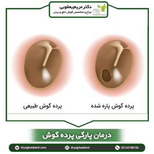 درمان پارگی پرده گوش _ دکتر مریم یعقوبی