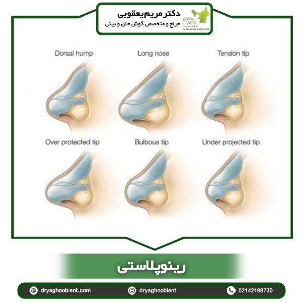 رینوپلاستی - دکتر مریم یعقوبی