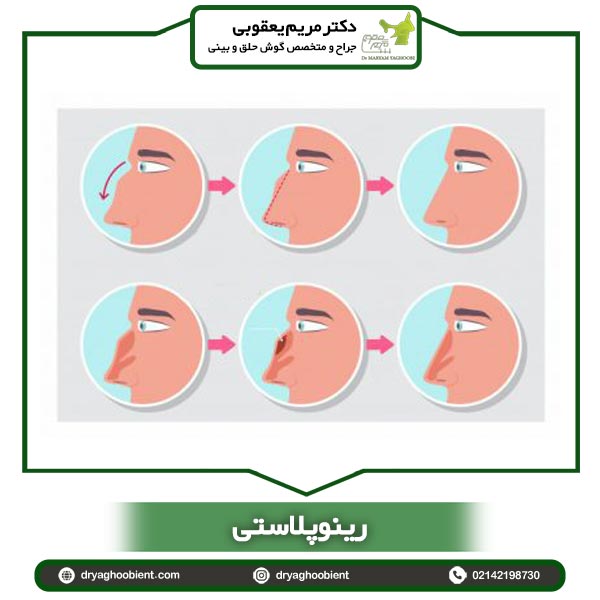 رینوپلاستی - دکتر مریم یعقوبی