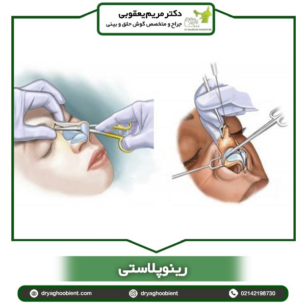 رینوپلاستی - دکتر مریم یعقوبی