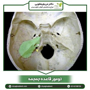 تومور قاعده جمجمه _ دکتر یعقوبی