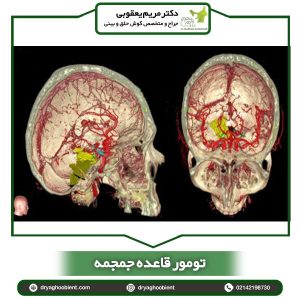 تومور قاعده جمجمه _ دکتر یعقوبی