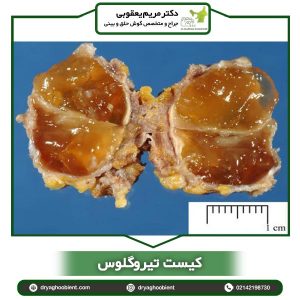 کیست تیروگلوس