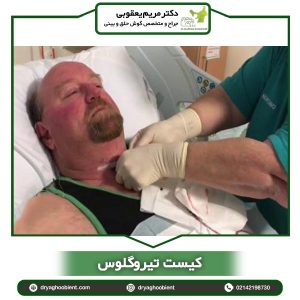 کیست تیروگلوس